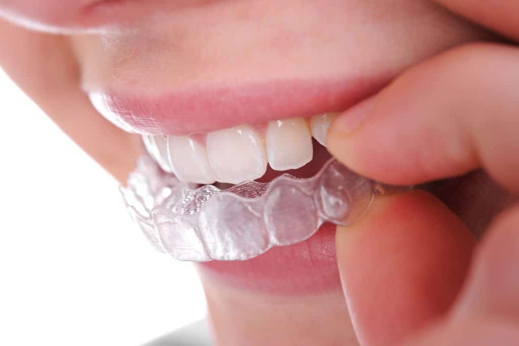 4 Benefits of Invisalign Over Traditional Braces