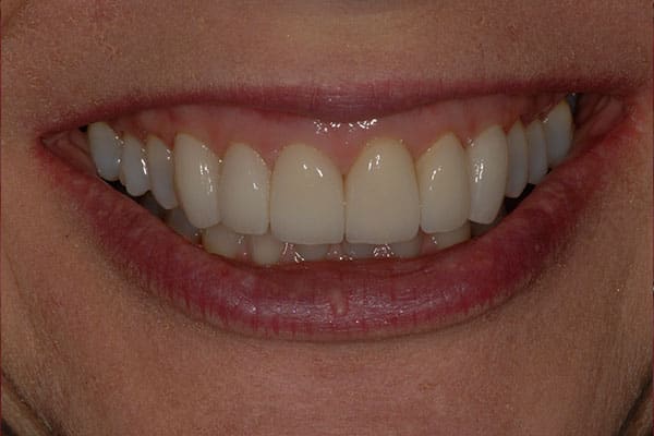 Finished Veneers