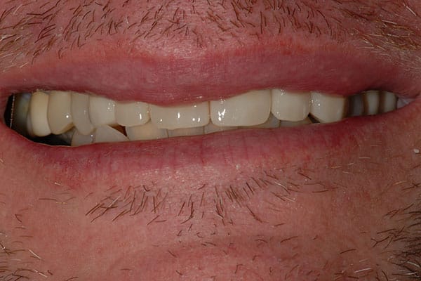 Teeth Bridge After Treatment