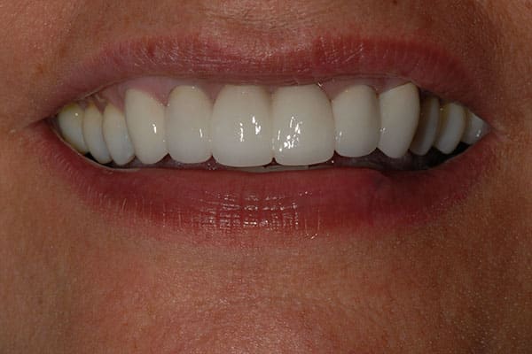 Teeth Bridge After Treatment