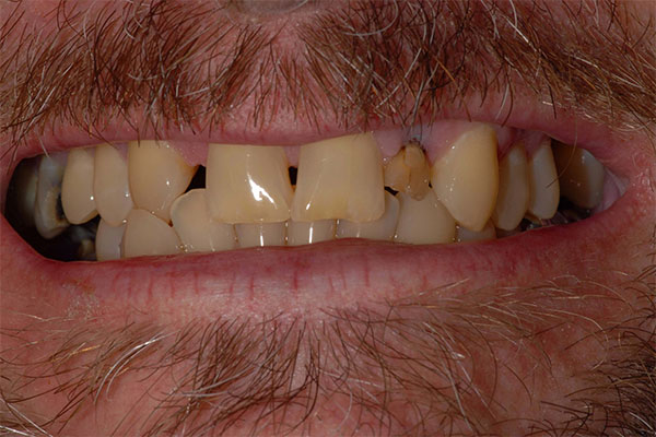 Before Teeth Bridge work