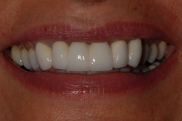 Before Teeth Bridge work