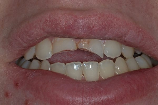 Broken teeth before repair