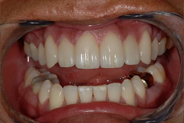 Cb-Veneers After