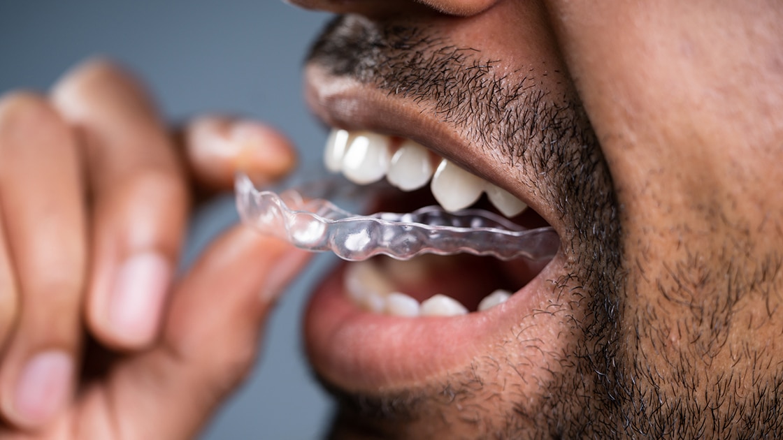 SureSmile® Clear Aligners