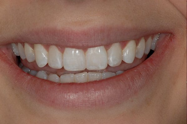 composite veneers after