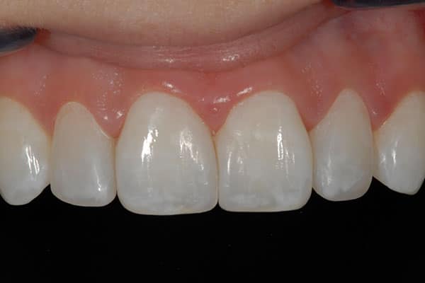 composite veneers after