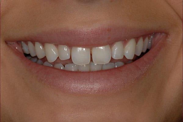 composite veneers before