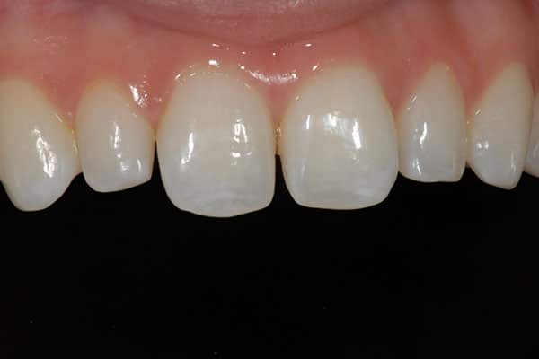 composite veneers before