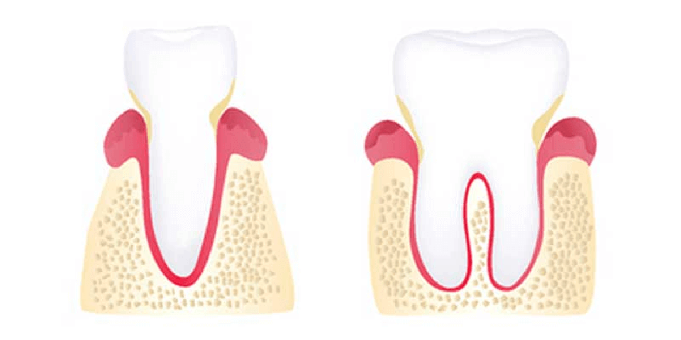 Early periodontitis illustration