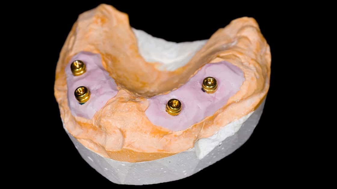 Full Arch Implants