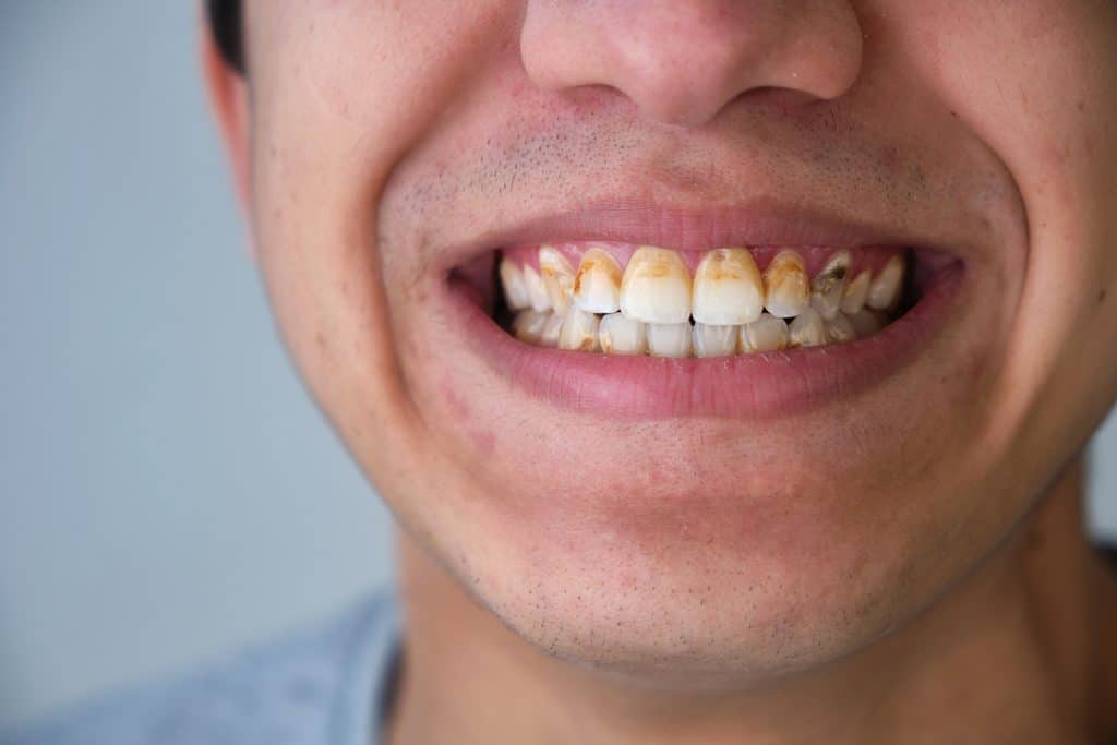 Restoring Teeth Damaged by Albuquerque’s Hard Water: Special Considerations