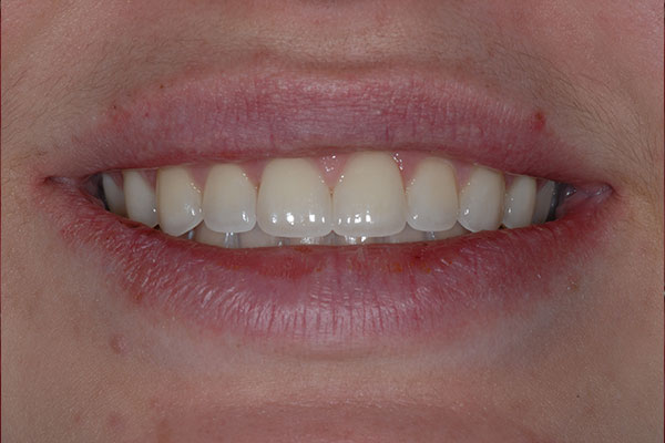 Veneers After