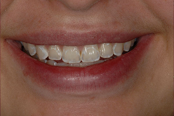 Veneers Before