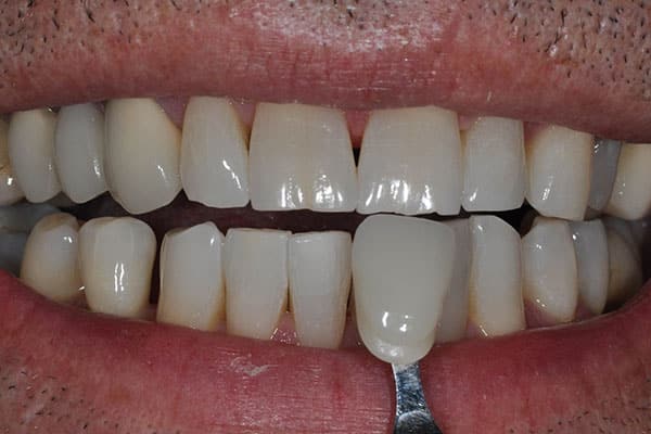 whitening after