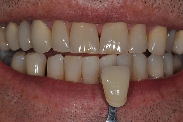 whitening before